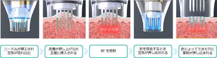 薬剤を均一に浸透させて治療を効果高めるドラッグデリバリーシステム