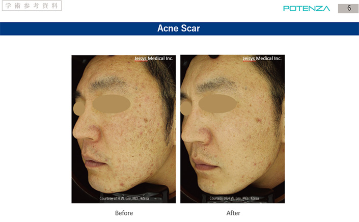 Acne Scar