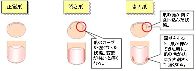 陥入爪