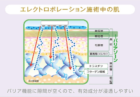 医療脱毛ソプラノアイス